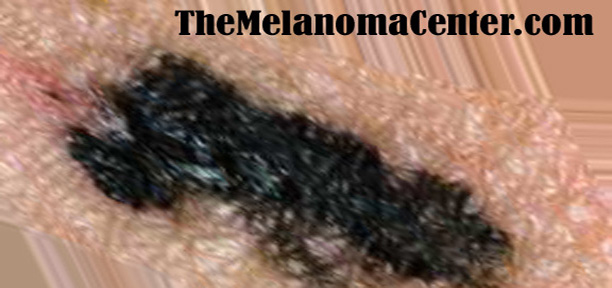TheMelanomaCenter.com